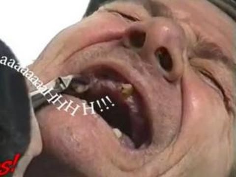 Funny Tooth Extraction…OUCH!