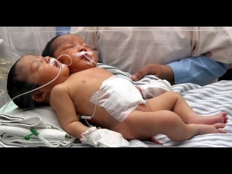 The Twin Within The Twin – Extraordinary People – Documentary